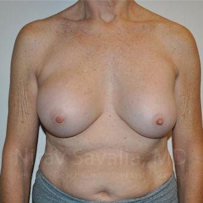 Male Breast Reduction Before & After Gallery - Patient 1655567 - Before