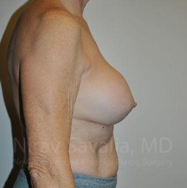 Male Breast Reduction Before & After Gallery - Patient 1655567 - Before