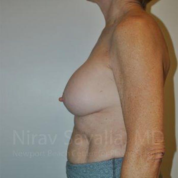 Male Breast Reduction Before & After Gallery - Patient 1655567 - Before