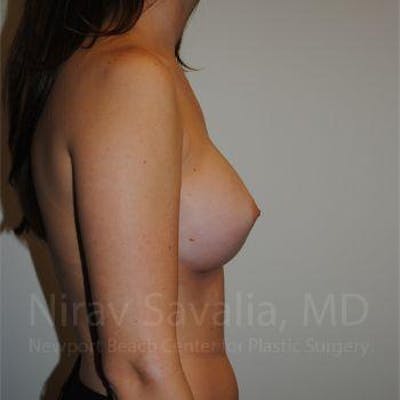 Male Breast Reduction Before & After Gallery - Patient 1655574 - After