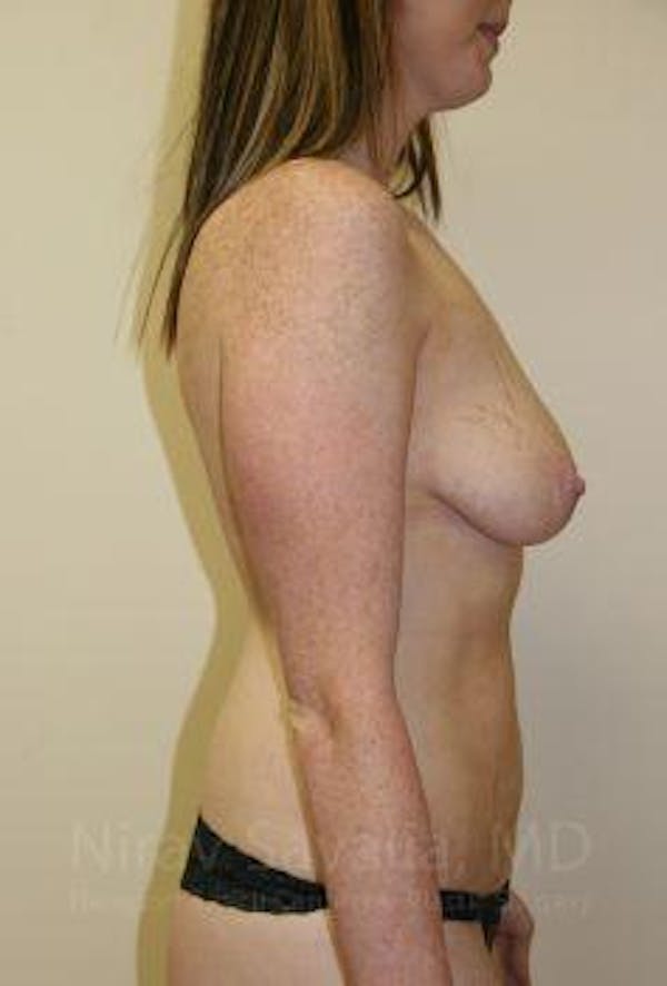 Abdominoplasty Tummy Tuck Before & After Gallery - Patient 1655579 - Before