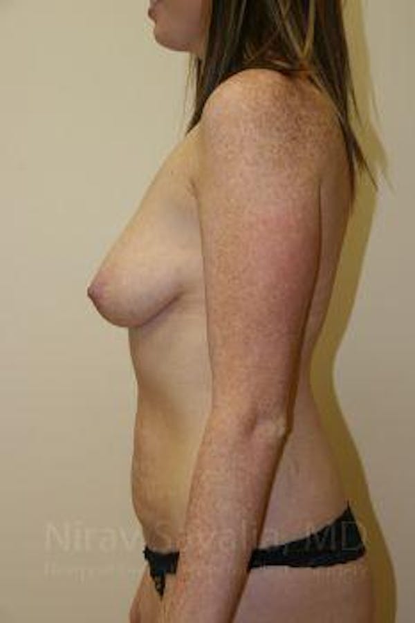 Abdominoplasty Tummy Tuck Before & After Gallery - Patient 1655579 - Before