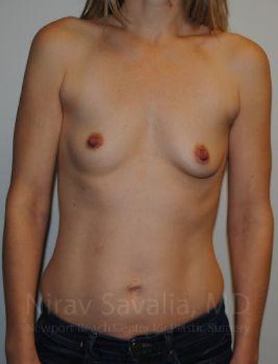 Breast Lift without Implants Before & After Gallery - Patient 1655580 - Before