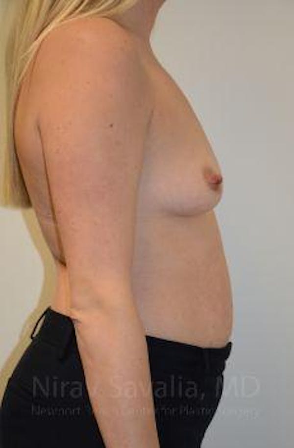 Fat Grafting to Face Before & After Gallery - Patient 1655585 - Before