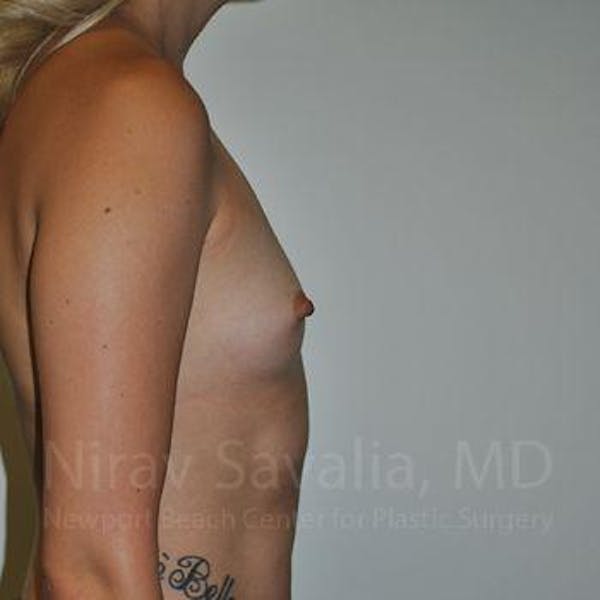 Male Breast Reduction Before & After Gallery - Patient 1655595 - Before