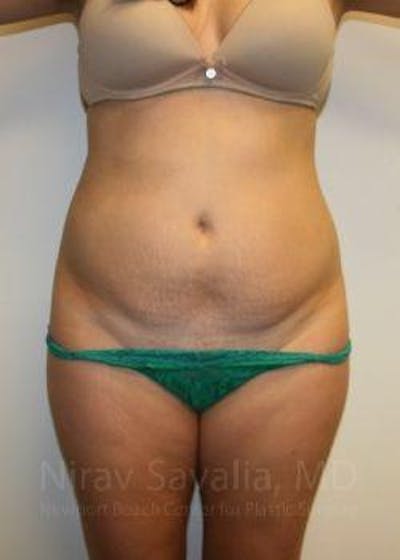 Breast Lift without Implants Before & After Gallery - Patient 1655598 - Before