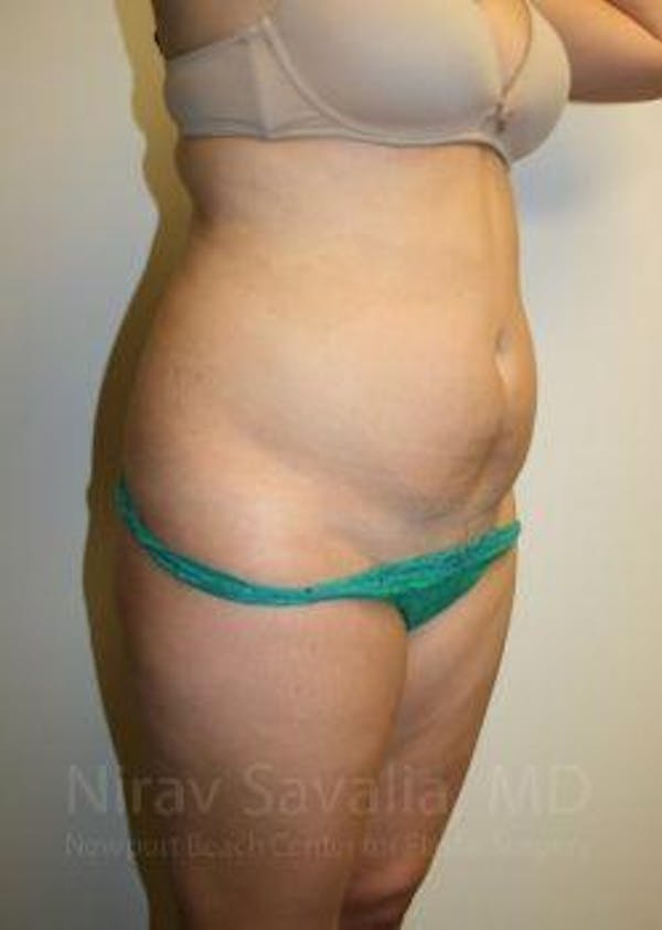 Breast Lift without Implants Before & After Gallery - Patient 1655598 - Before