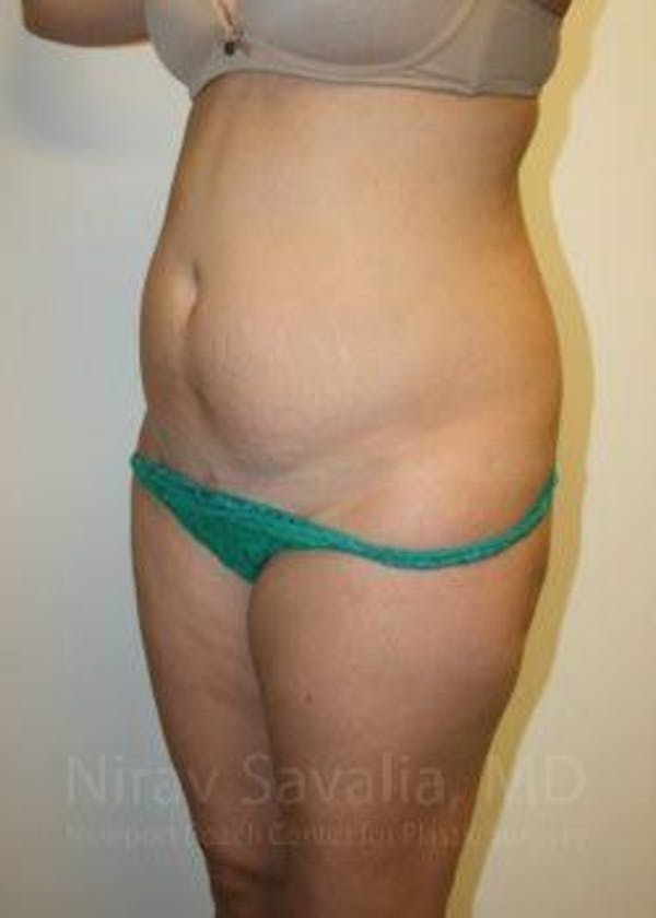 Breast Lift without Implants Before & After Gallery - Patient 1655598 - Before