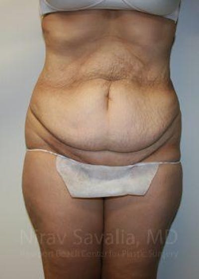 Breast Reduction Before & After Gallery - Patient 1655601 - Before