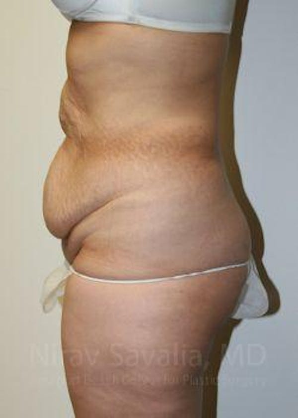 Breast Reduction Before & After Gallery - Patient 1655601 - Before