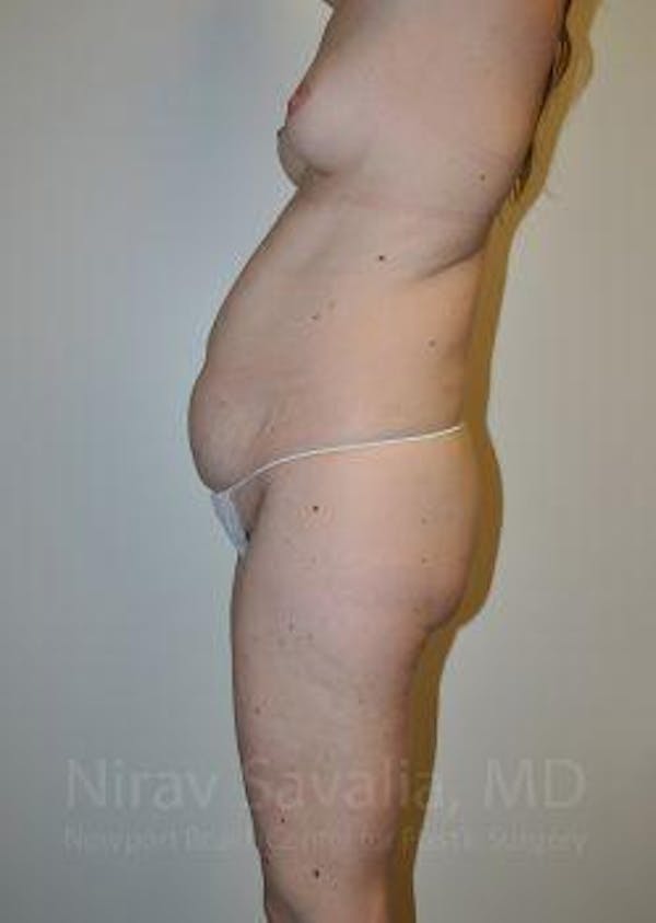 Male Breast Reduction Before & After Gallery - Patient 1655603 - Before