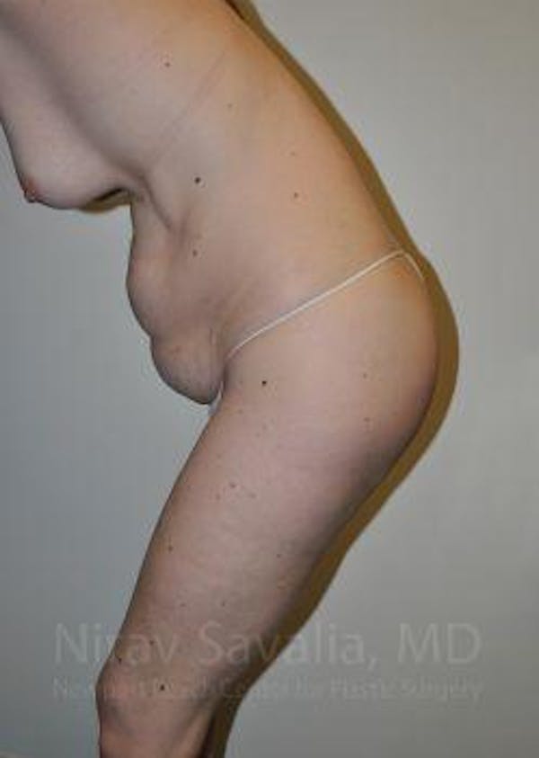 Male Breast Reduction Before & After Gallery - Patient 1655603 - Before