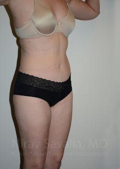 Male Breast Reduction Before & After Gallery - Patient 1655603 - After