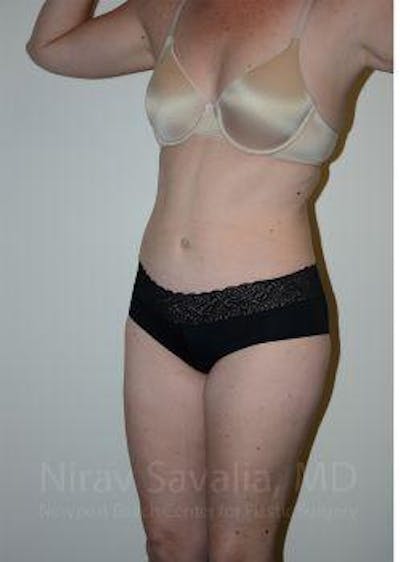 Breast Lift without Implants Before & After Gallery - Patient 1655605 - After