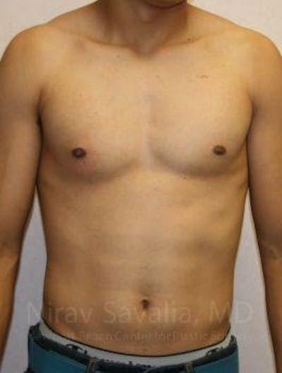 Breast Lift without Implants Before & After Gallery - Patient 1655607 - After