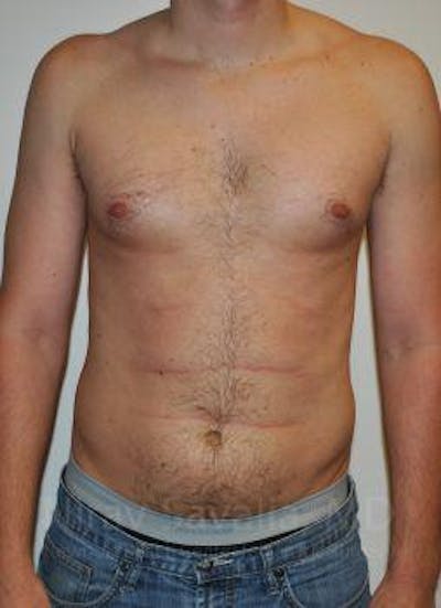 Abdominoplasty Tummy Tuck Before & After Gallery - Patient 1655612 - Before