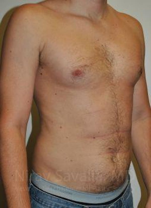 Abdominoplasty Tummy Tuck Before & After Gallery - Patient 1655612 - Before