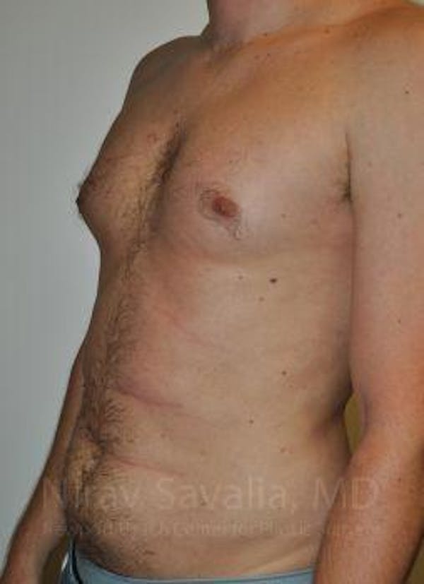 Abdominoplasty Tummy Tuck Before & After Gallery - Patient 1655612 - Before