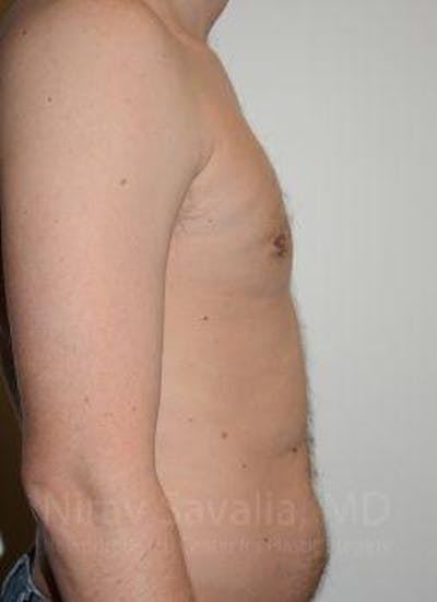 Abdominoplasty Tummy Tuck Before & After Gallery - Patient 1655612 - After