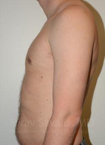 Abdominoplasty Tummy Tuck Before & After Gallery - Patient 1655612 - After