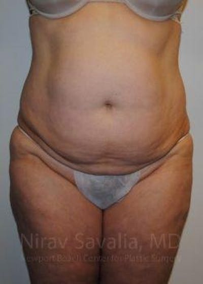 Liposuction Before & After Gallery - Patient 1655617 - Before