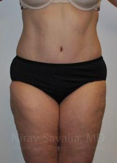 Liposuction Before & After Gallery - Patient 1655617 - After