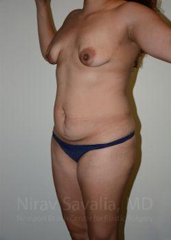 Breast Lift without Implants Before & After Gallery - Patient 1655619 - Before