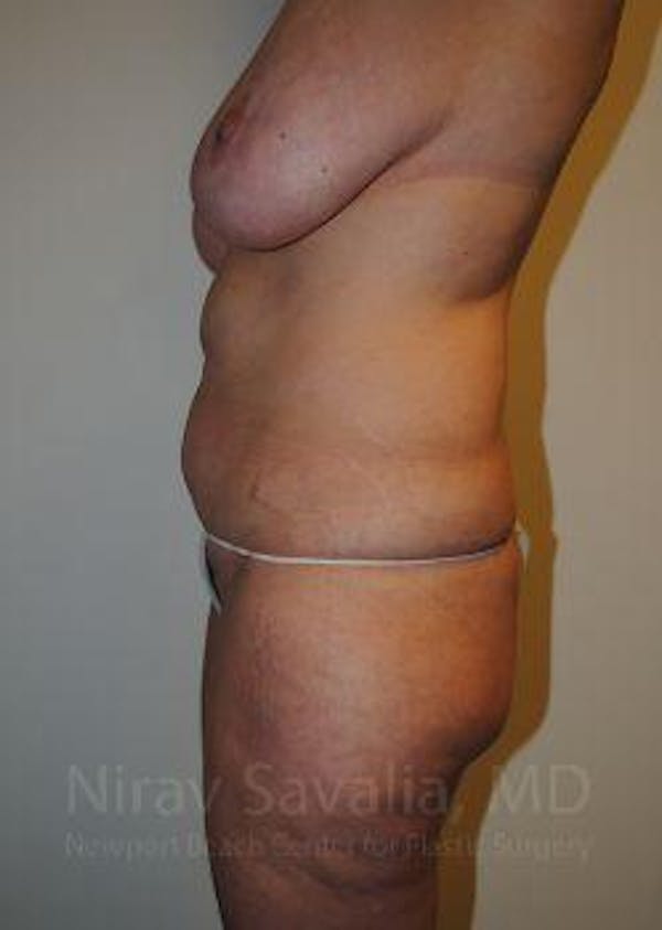 Male Breast Reduction Before & After Gallery - Patient 1655623 - Before