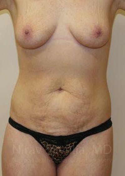 Male Breast Reduction Before & After Gallery - Patient 1655627 - Before