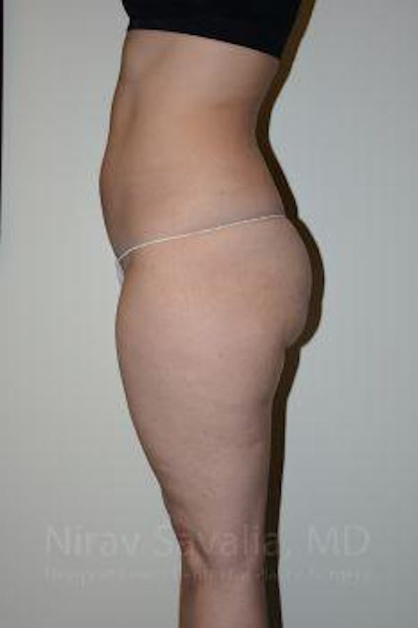 Abdominoplasty Tummy Tuck Before & After Gallery - Patient 1655629 - Before