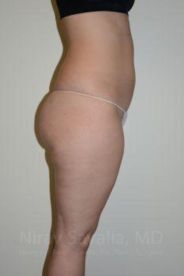 Abdominoplasty Tummy Tuck Before & After Gallery - Patient 1655629 - Before