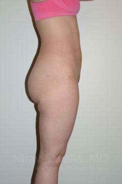 Abdominoplasty Tummy Tuck Before & After Gallery - Patient 1655629 - After