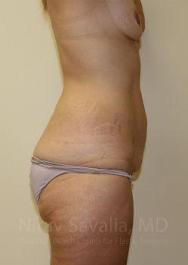 Abdominoplasty Tummy Tuck Before & After Gallery - Patient 1655631 - Before