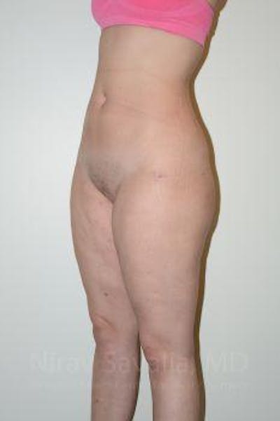 Abdominoplasty Tummy Tuck Before & After Gallery - Patient 1655629 - After