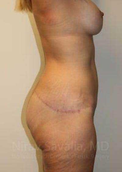 Abdominoplasty Tummy Tuck Before & After Gallery - Patient 1655631 - After