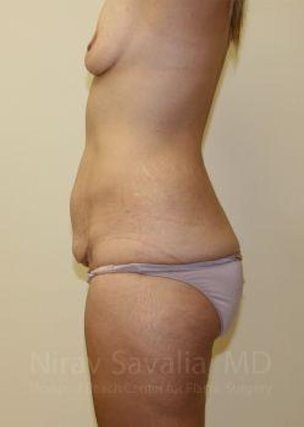 Male Breast Reduction Before & After Gallery - Patient 1655630 - Before