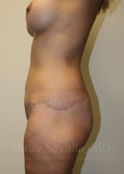 Male Breast Reduction Before & After Gallery - Patient 1655630 - After