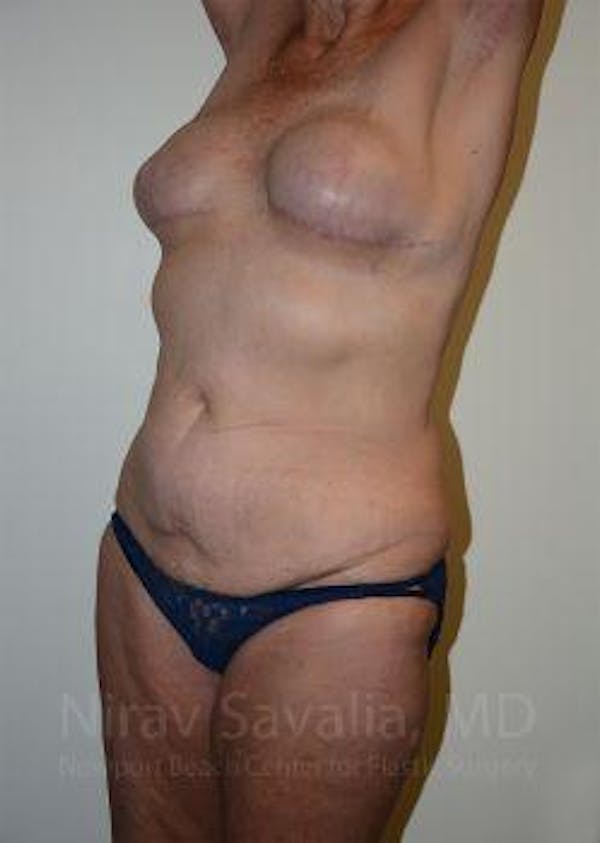 Abdominoplasty Tummy Tuck Before & After Gallery - Patient 1655634 - Before