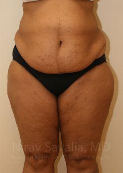 Fat Grafting to Face Before & After Gallery - Patient 1655636 - Before