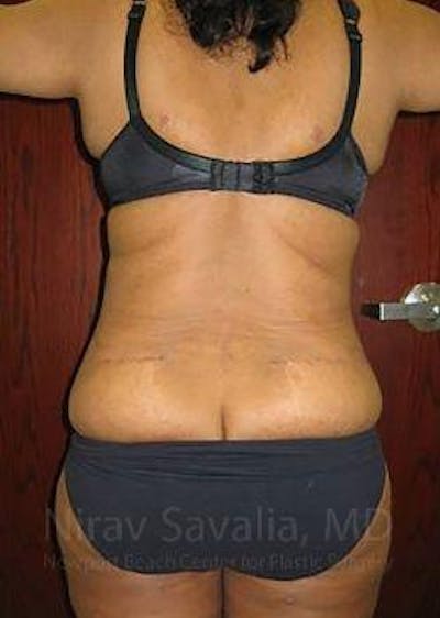 Fat Grafting to Face Before & After Gallery - Patient 1655636 - After