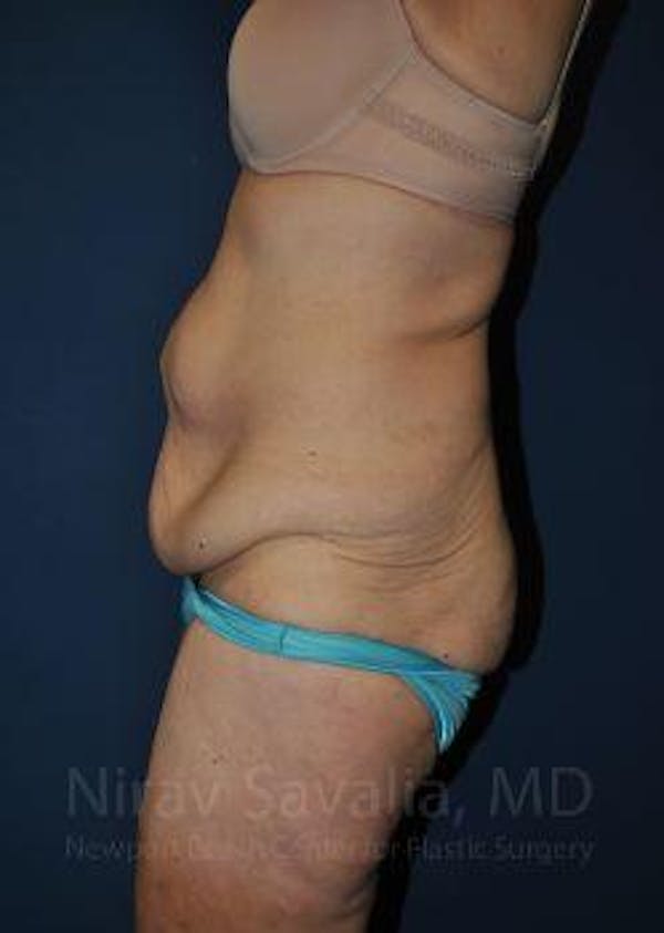 Breast Reduction Before & After Gallery - Patient 1655640 - Before