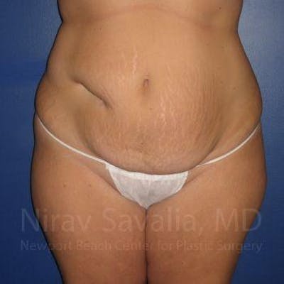 Male Breast Reduction Before & After Gallery - Patient 1655647 - Before