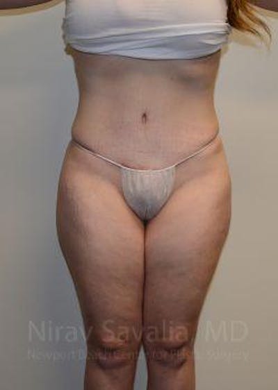 Breast Lift without Implants Before & After Gallery - Patient 1655652 - After