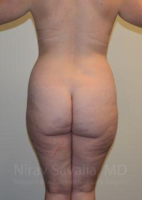 Breast Lift without Implants Before & After Gallery - Patient 1655652 - Before