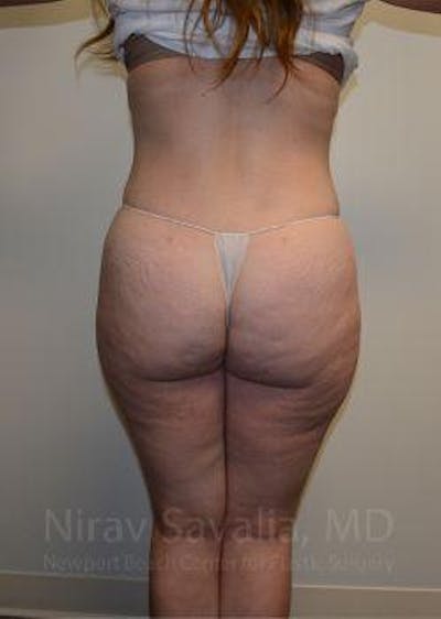 Breast Lift without Implants Before & After Gallery - Patient 1655652 - After