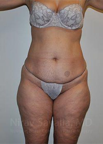 Fat Grafting to Face Before & After Gallery - Patient 1655654 - Before