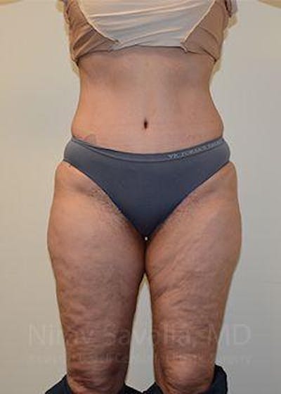 Fat Grafting to Face Before & After Gallery - Patient 1655654 - After