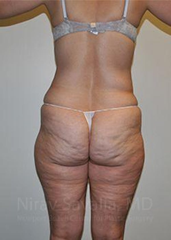 Fat Grafting to Face Before & After Gallery - Patient 1655654 - Before