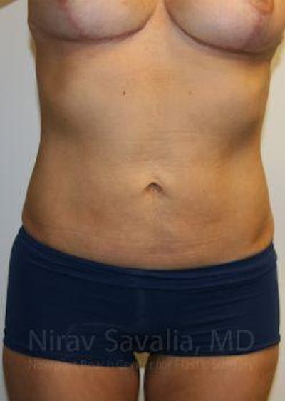 Breast Reduction Before & After Gallery - Patient 1655658 - After