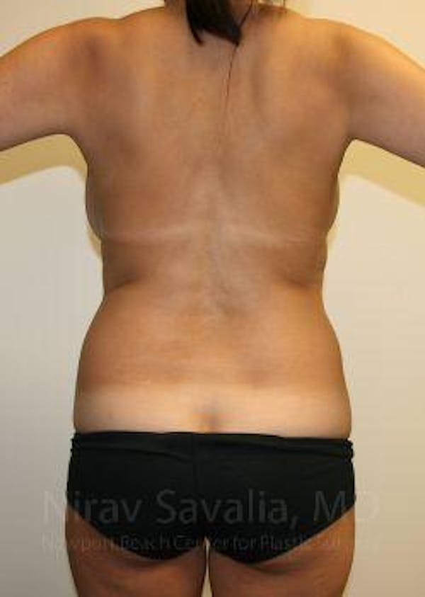 Breast Reduction Before & After Gallery - Patient 1655658 - Before